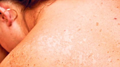 Un total de 21 mil casos de cáncer de piel se atendieron y mil 466 lesiones sospechosas se detectaron en cinco años que llevan las Jornadas de Detección de Cáncer de Piel.